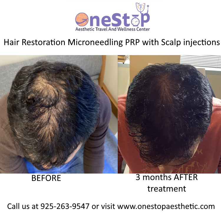 Microneedling PRP for hair Restoration