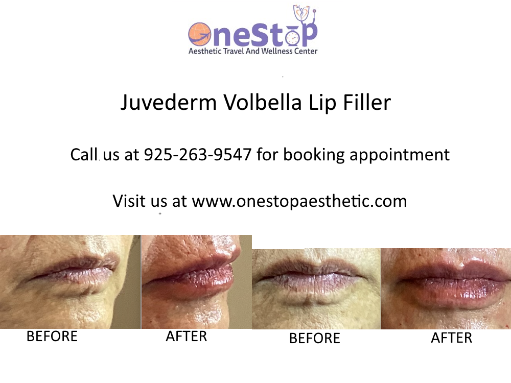 Juvederm Volbella lip filler - before and after
