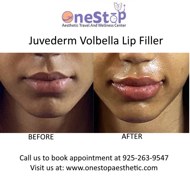 Juvederm Volbella lip filler - Before and After