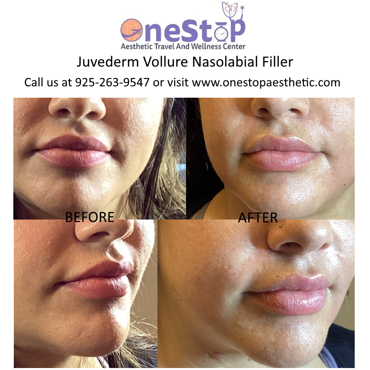 Juvederm Vollure Nasolabial Filler - Before and After