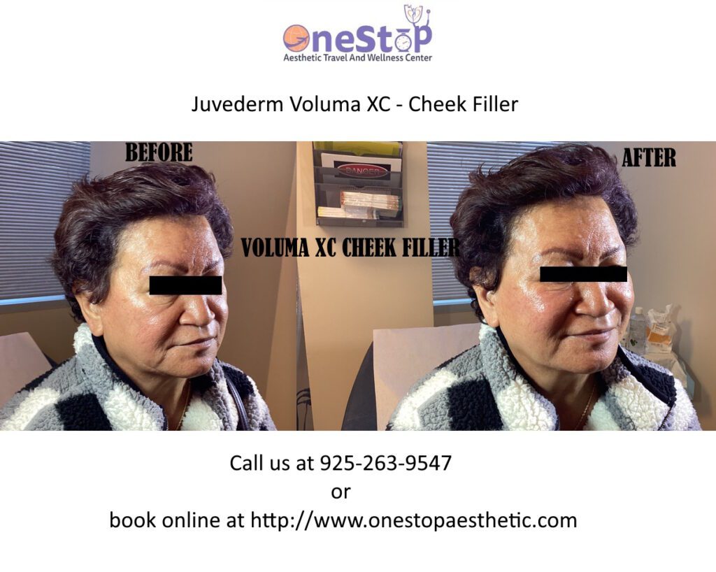 Juvederm Voluma XC - Cheek Filler - Before and After