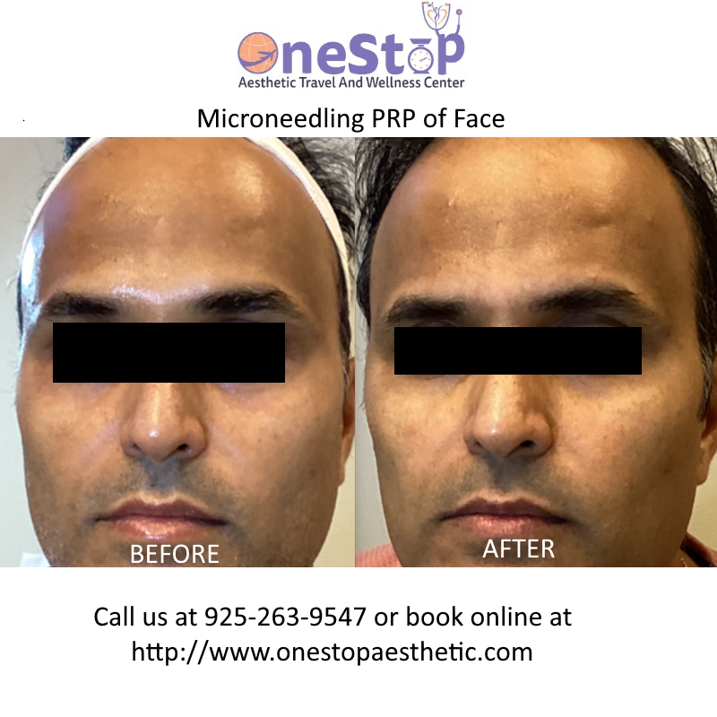 Microneedling PRP - Before and After