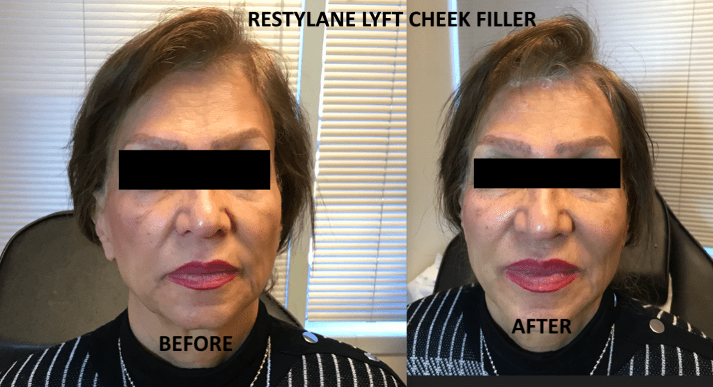 Restylane Lyft Cheek Filler - Before and After