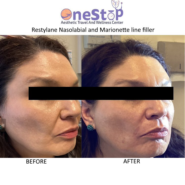 Restylane Nasolabial Marionette line Filler - Before and After