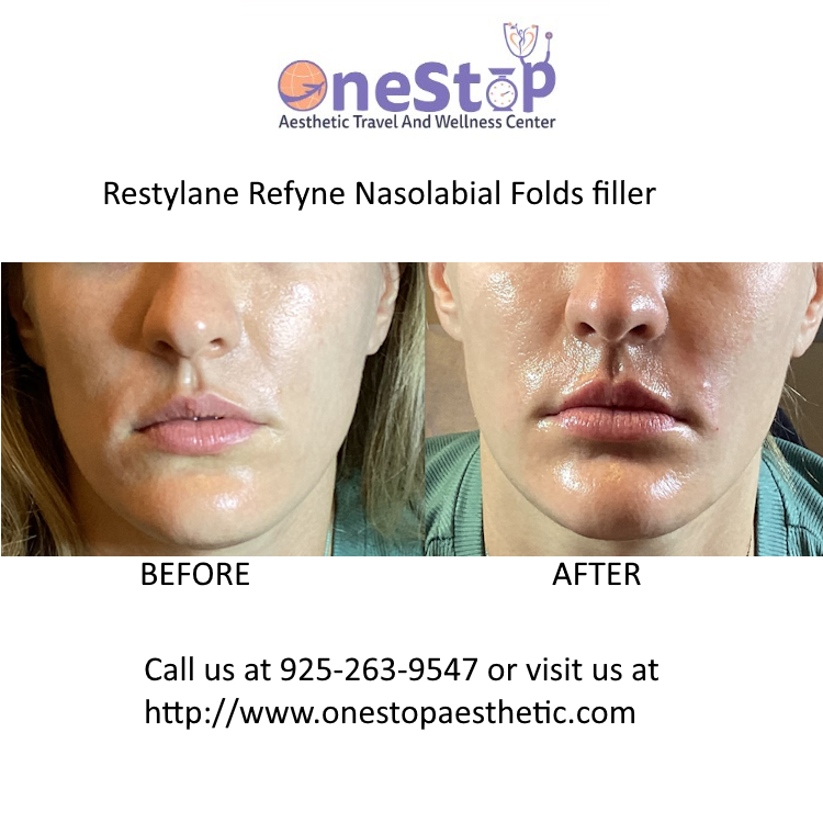 Restylane Refyne Nasilabial Filler - Before and After