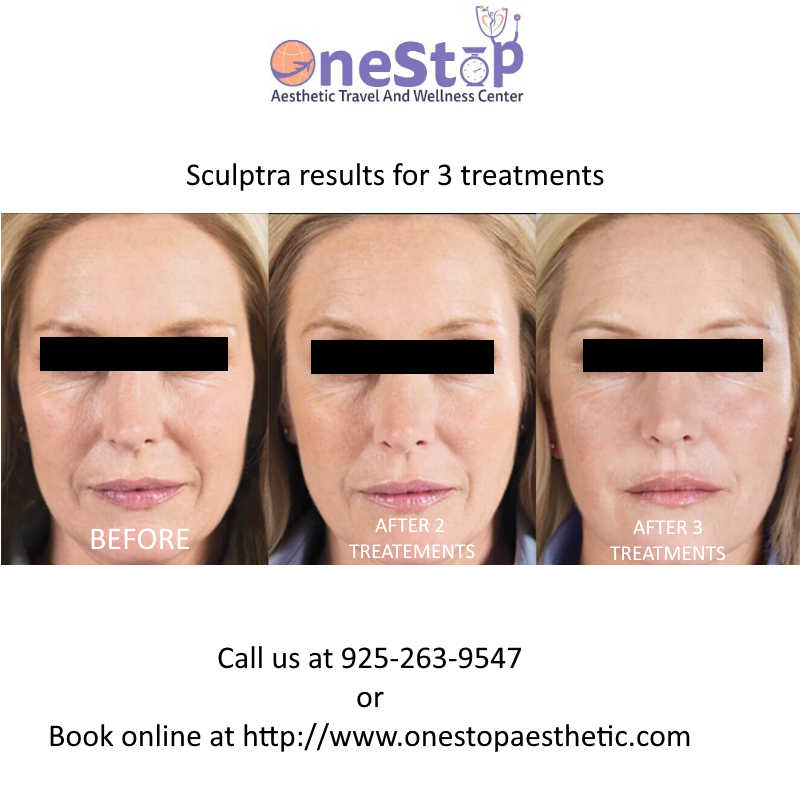 Sculptra before and after three treatments