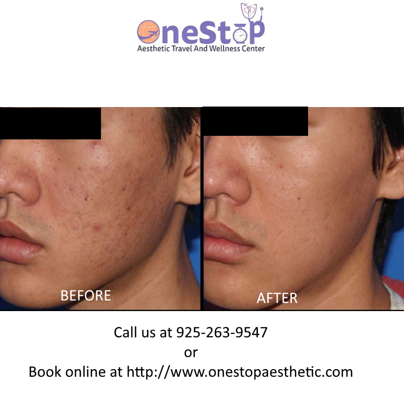 Microneedling PRP Face - Before and After