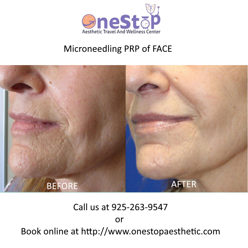 Microneedling PRP of Face - Before and After