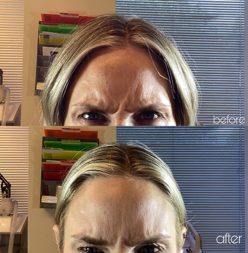 Botox forehead before and after