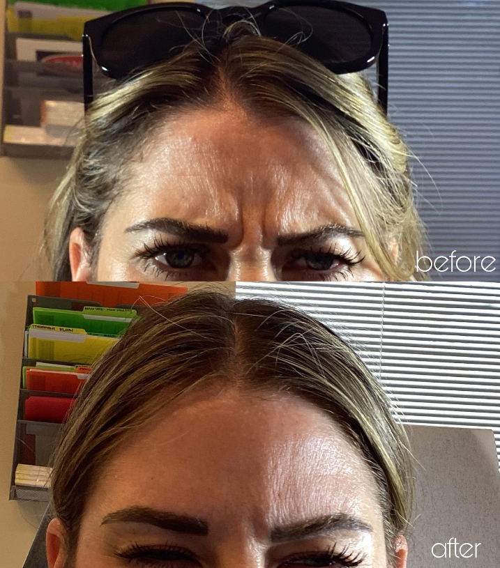 Botox forehead before and after 2
