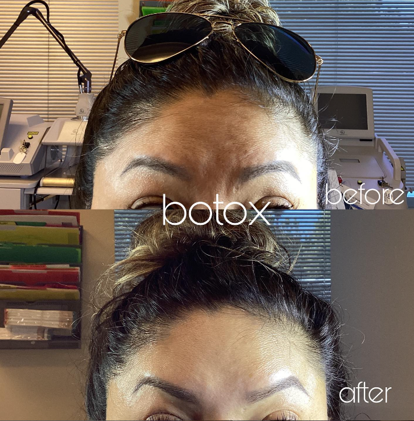Botox before and after eyes