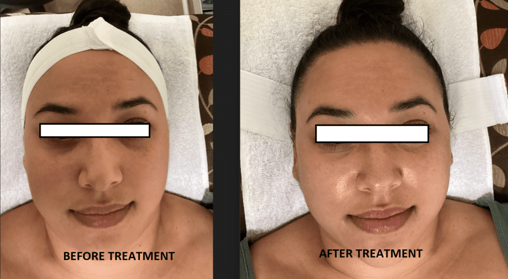 Hydrodermabrasion Before and After