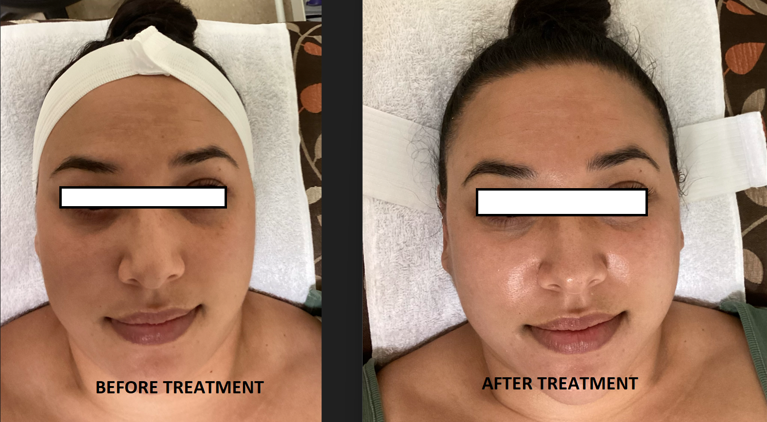 Hyfacial Before and After - Eye covered