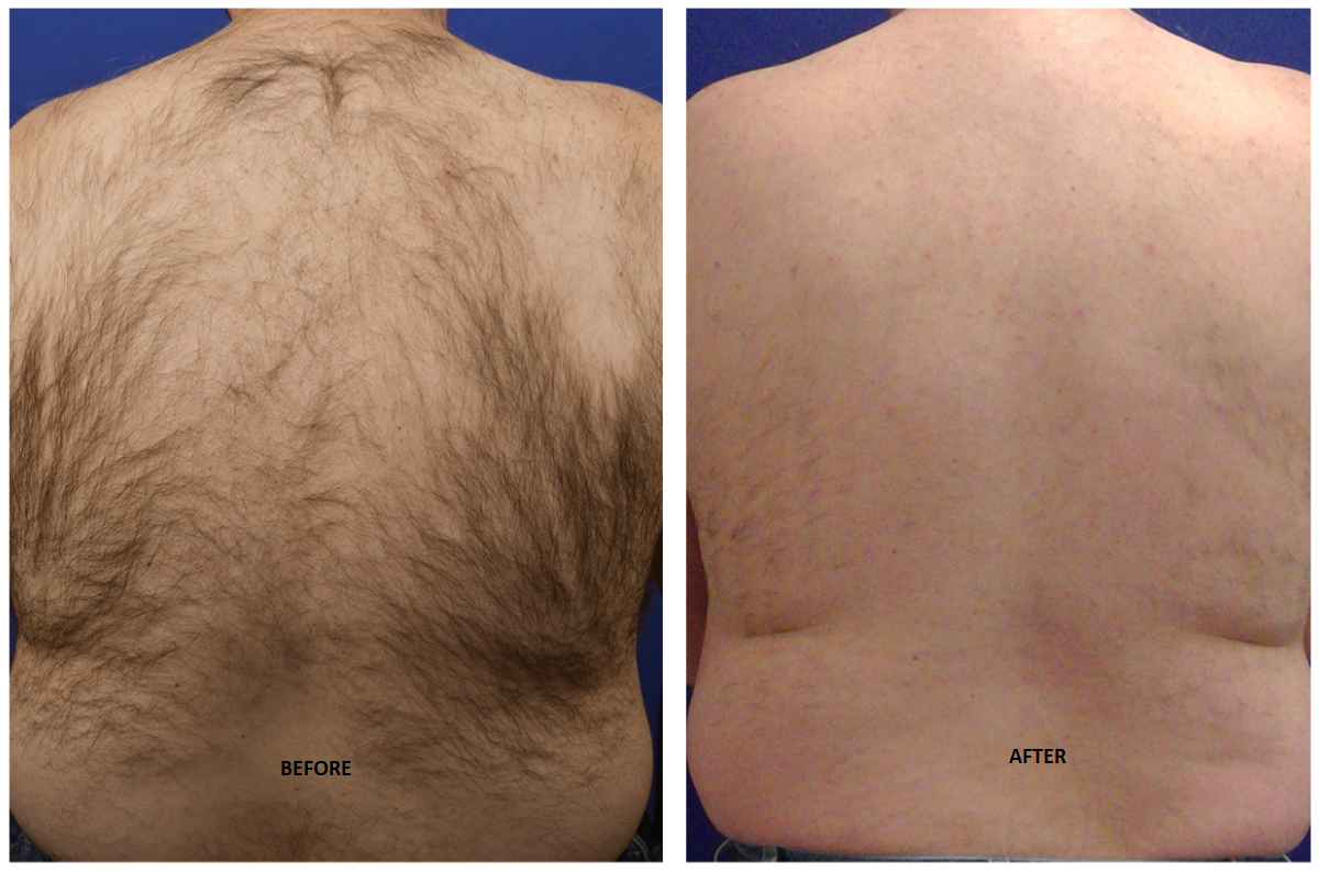 Diode Laser hair Removal before and after