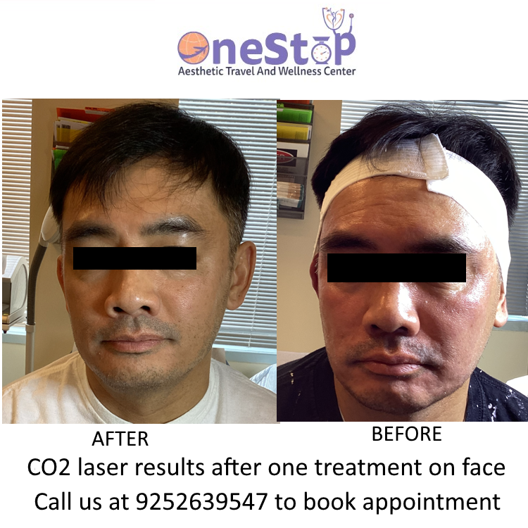 CO2 laser before and after for face