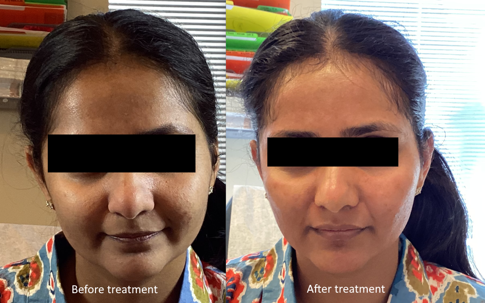 Microneedling face before and after