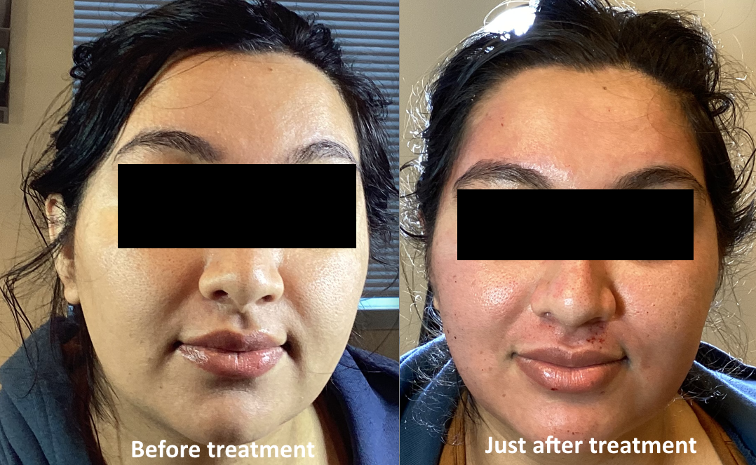 Microneedling Face just after microneedling