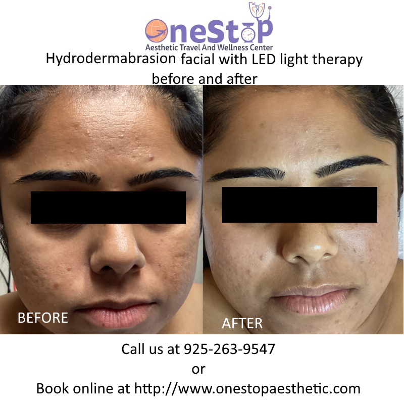 Hydrodermabrasion with LED therapy before and after